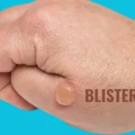What Are the Best Treatment Options for blisterata?