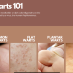 Types of warts: Pictures, Symptoms, and Causes