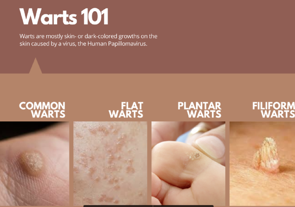 Types of warts: Pictures, Symptoms, and Causes