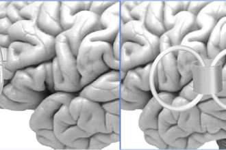 Neuroscientific Mechanisms Behind TMS Therapy And How It Affects Brain Activity And Neurotransmitter Levels: