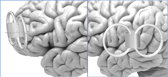 Neuroscientific Mechanisms Behind TMS Therapy And How It Affects Brain Activity And Neurotransmitter Levels: