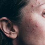 Common Skin Conditions and Their Treatments