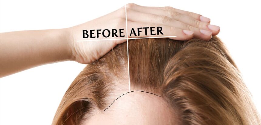 Benefits of Hair Restoration for Women