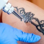 Tattoo Removal Cost: What to Expect and How to Save