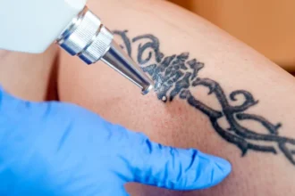 Tattoo Removal Cost: What to Expect and How to Save