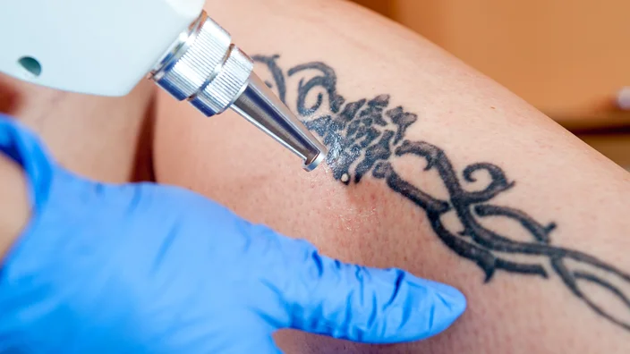 Tattoo Removal Cost: What to Expect and How to Save