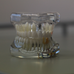 Dentures vs. Dental Implants: What’s Right for You