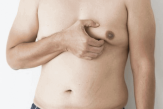 Gynecomastia and Body Image: Coping Strategies and Treatments