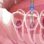 Endodontic Technology Trends: What’s Next for Root Canal Treatment?