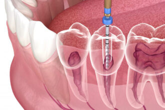 Endodontic Technology Trends: What’s Next for Root Canal Treatment?