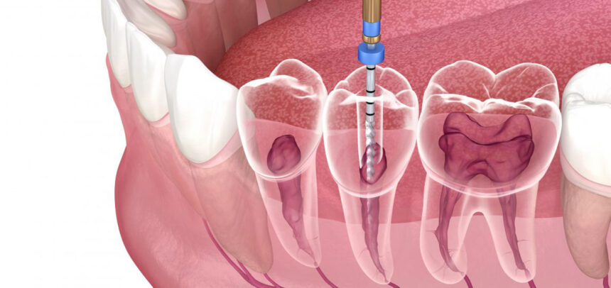 Endodontic Technology Trends: What’s Next for Root Canal Treatment?