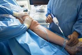 The Benefits of Minimally Invasive Vein Treatments