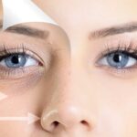 Under Eye Filler: The Solution to Dark Circles and Hollow Eyes