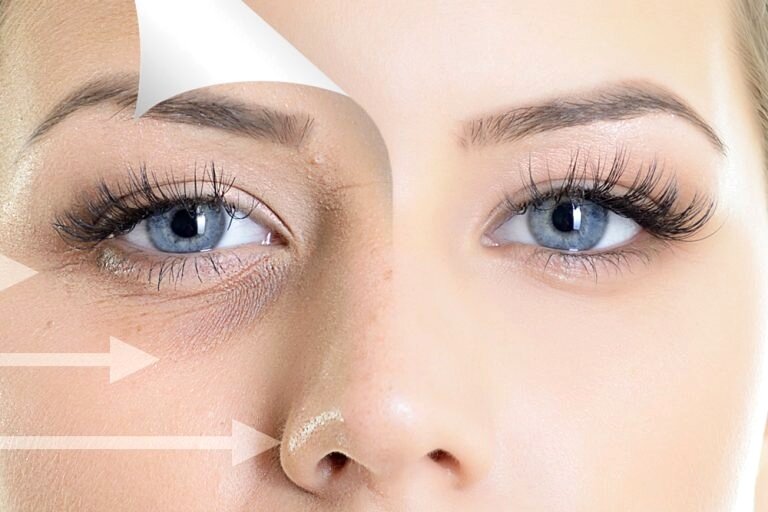 Under Eye Filler: The Solution to Dark Circles and Hollow Eyes