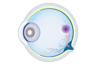 What Is GA Eye Condition and Why Is It Important?