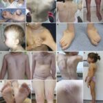 23 Signs You Grew Up with Ehlers-Danlos Syndrome