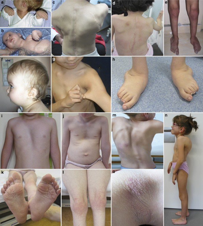 23 Signs You Grew Up with Ehlers-Danlos Syndrome
