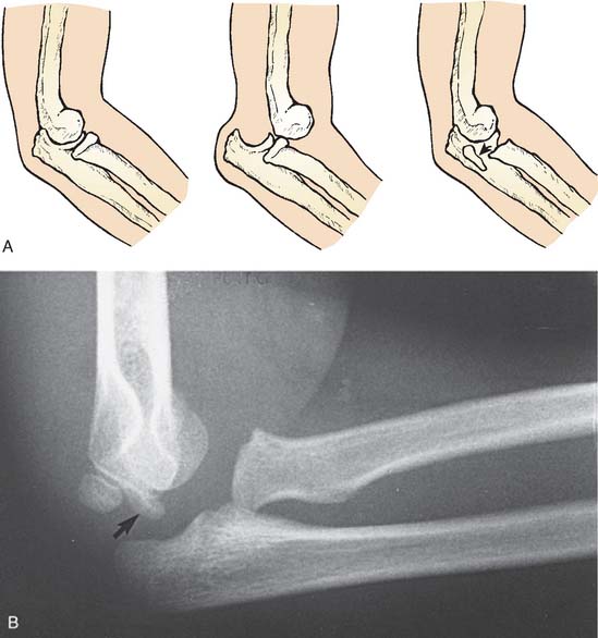 Dislocations Were Casual Occurrences