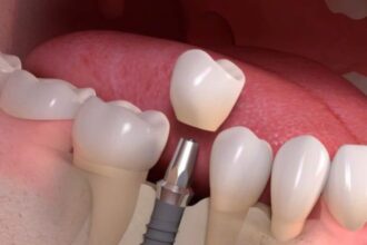 Dental Implants