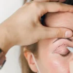 Eyelid Concerns