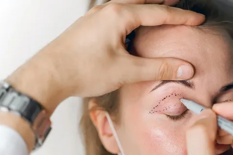 Eyelid Concerns