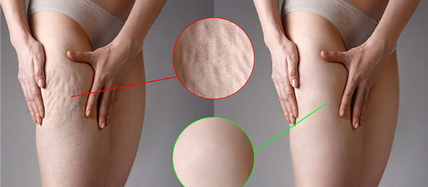 When Should You Seek Treatment for Cellulogia?
