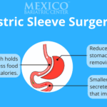 Gastric Sleeve