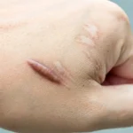 Keloid Scars