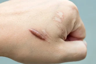 Keloid Scars