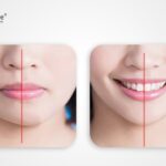 does invisalign change your jaw