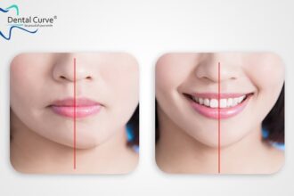 does invisalign change your jaw