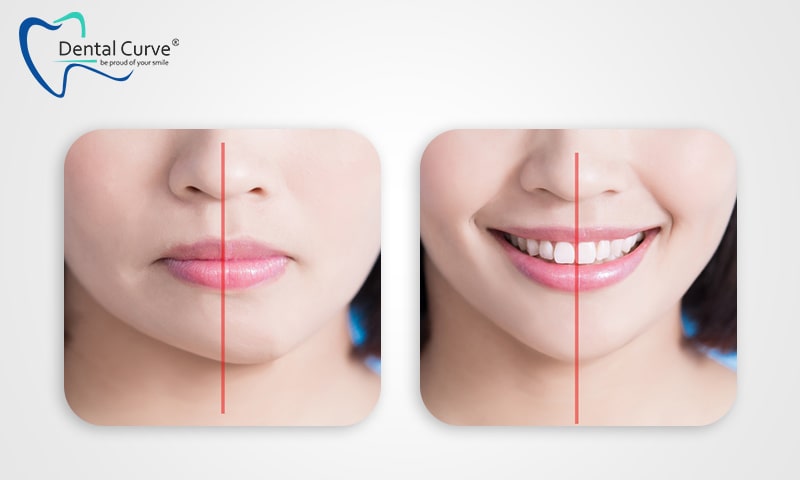 does invisalign change your jaw
