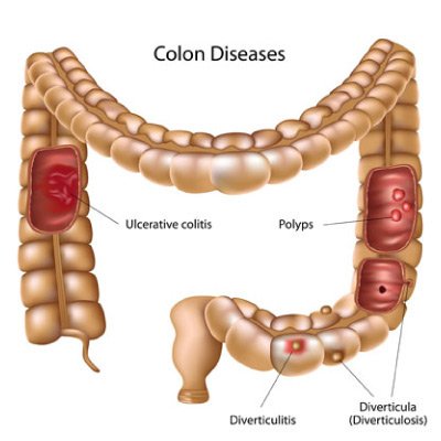 what does poop look like with diverticulitis
