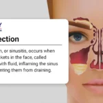 is a sinus infection contagious