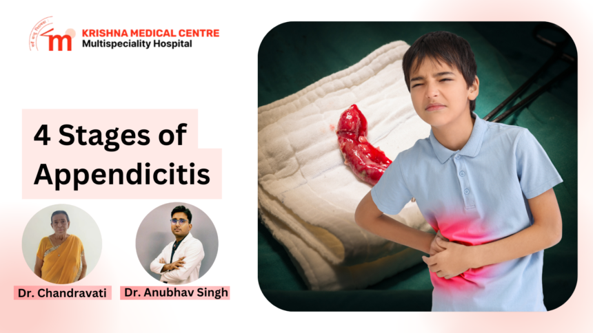 4 stages of appendicitis
