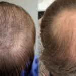 Do You Have to Take Finasteride After Hair Transplant?