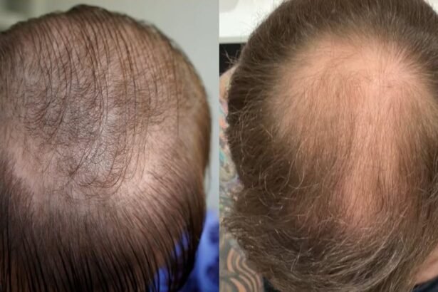 Do You Have to Take Finasteride After Hair Transplant?