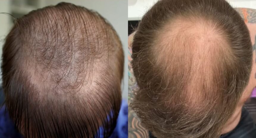 Do You Have to Take Finasteride After Hair Transplant?